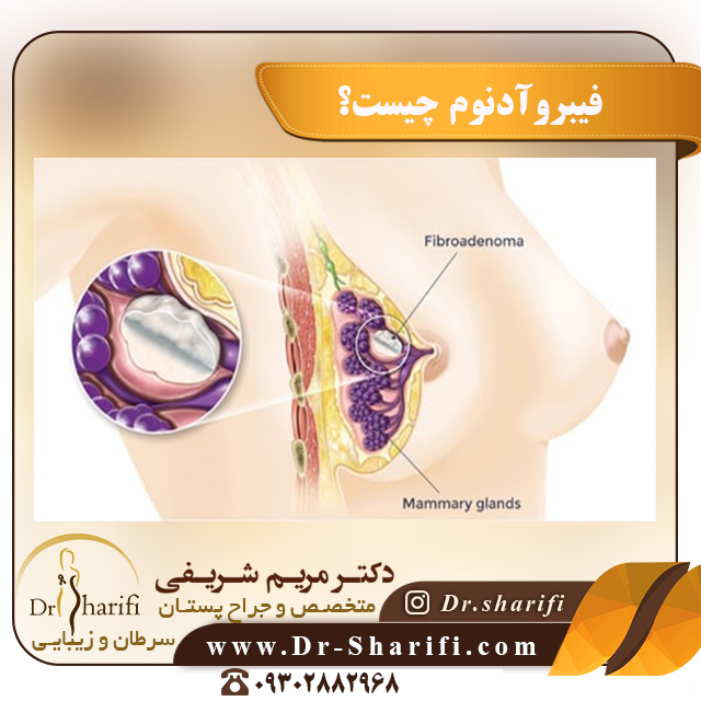 فیبروآدنوم چیست