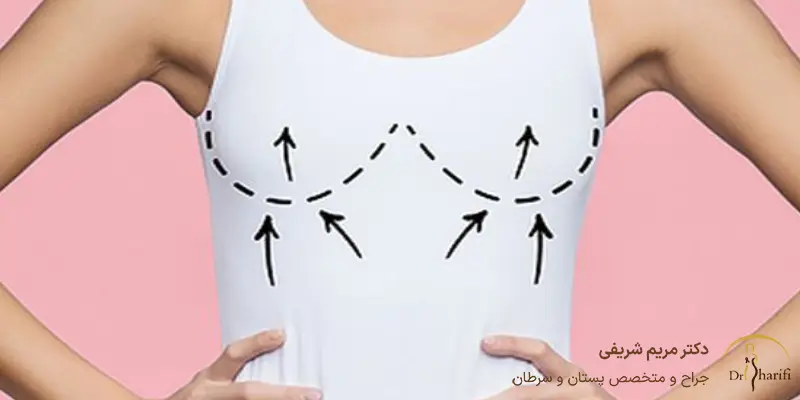 مراقبت های بعد از جراحی لیفت سینه