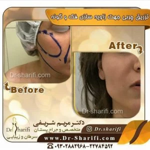 تزریق چربی به صورت