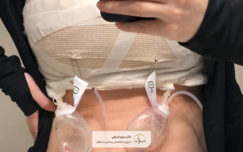دوره نقاهت بعد از جراحی ماموپلاستی در ماه اول چگونه است