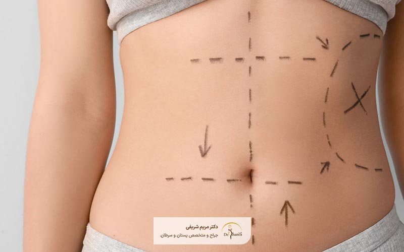 هزینه لیپوماتیک در سال ۱۴۰۴ چقدر برآورد میشود؟