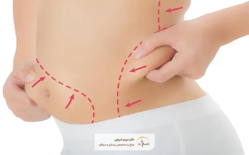 آیا بیمه قیمت و هزینههای عمل جراحی لیپوماتیک شکم پهلو و سایر نقاط را پرداخت میکند؟