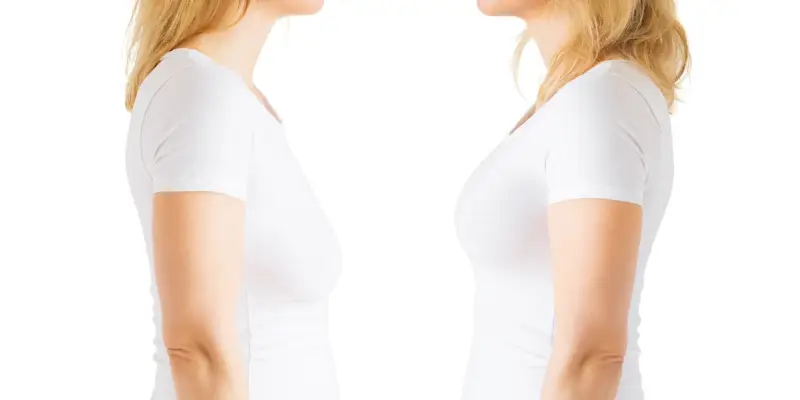 ایجاد اسکار از عوارض جراحی لیفت سینه