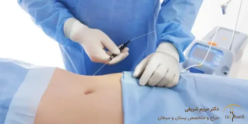 اقدامات بعد از لیپوماتیک