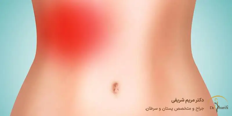 درد لیپوماتیک شکم