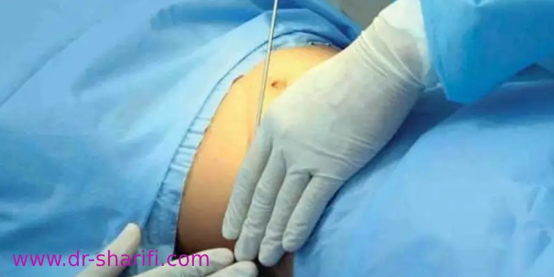 آیا لیپوماتیک جای زخم به جا میگذارد؟