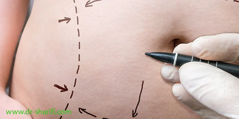 چه مدت باید گن طبی بعد از لیپوماتیک را استفاده کنیم؟