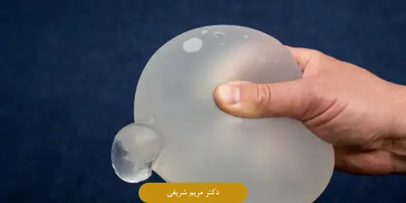 خطر ترکیدن پروتز سینه بیشتر در چه افرادی وجود دارد؟
