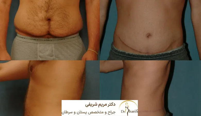 مراقبت های بعد از ابدومینوپلاستی