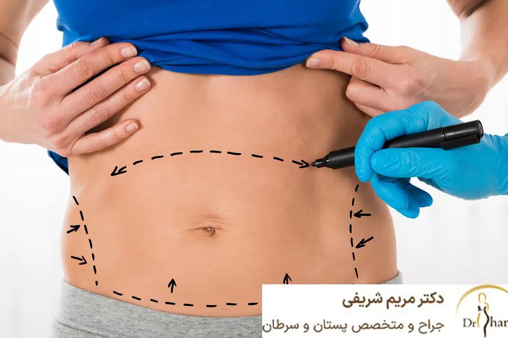 مراقبت های بعد از ابدومینوپلاستی