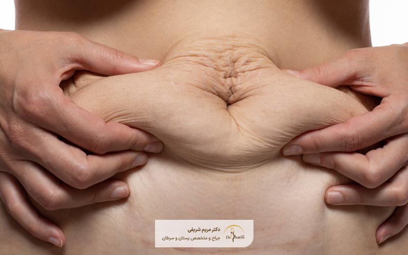مزایای جراحی زیبایی شکم توسط بهترین پزشک جراح ابدومینوپلاستی چیست