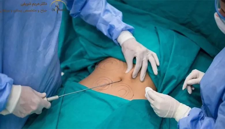 عوارض ابدومینوپلاستی