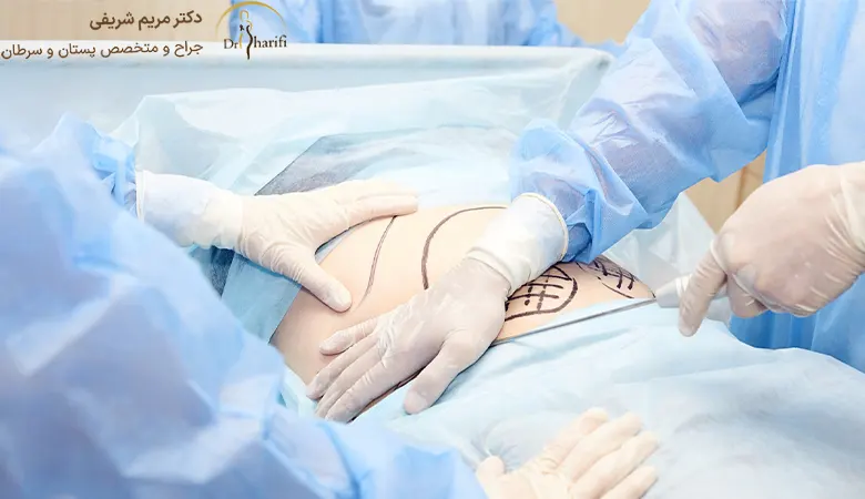 عوارض ابدومینوپلاستی