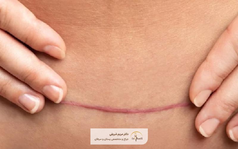 ماندن جای زخم بعد از عمل تامی تاک یکی از عوارض ابدومینوپلاستی است