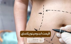 قیمت ابدومینوپلاستی در سال ۱۴۰۴ و بررسی عوامل موثر بر هزینه جراحی زیبایی شکم در سال 1404