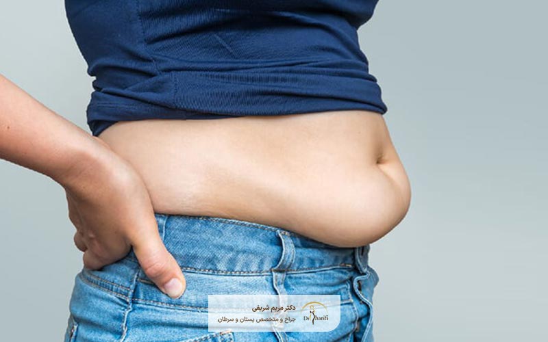 نوع رویه عمل جراحی زیبایی شکم میتواند بر هزینه ابدومینوپلاستی شکم تاثیر گذار باشد