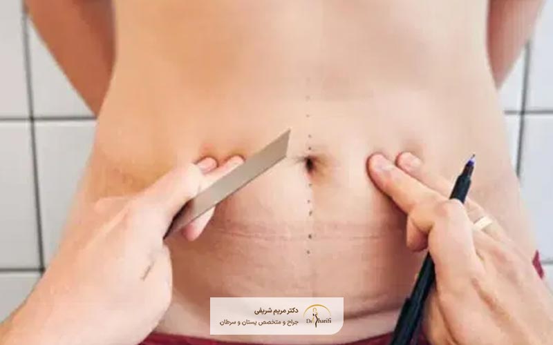 قیمت عمل زیبایی شکم و ابدومینوپلاستی در سال ۱۴۰۴