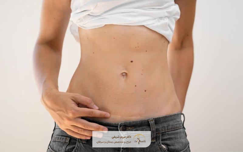 هزینه مینی ابدومینوپلاستی چقدر است؟