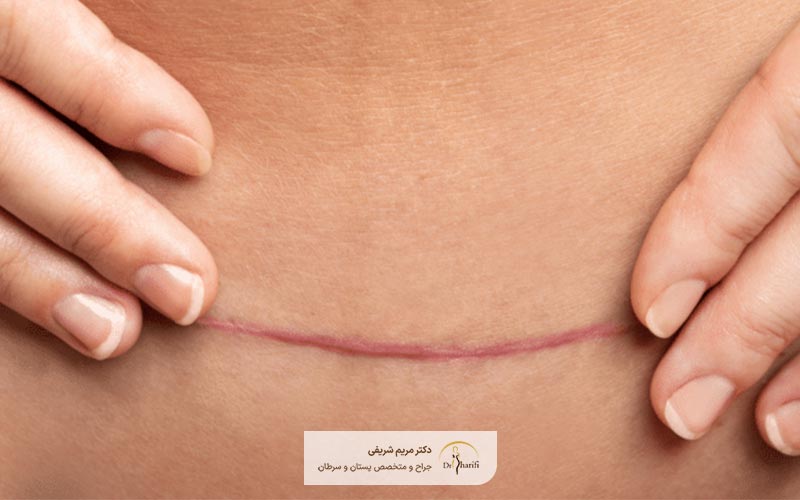 مقایسه تفاوت مینی ابدومینوپلاستی با عمل ابدو کامل