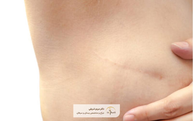 چه فعالیت های روزانه ای را بعد از ماستکتومی باید انجام دهیم؟