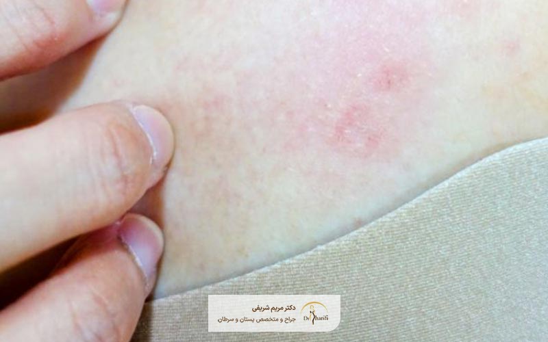 یکی از علائم سرطان سینه در زنان قرمز شدن پوست در ناحیه پستان است